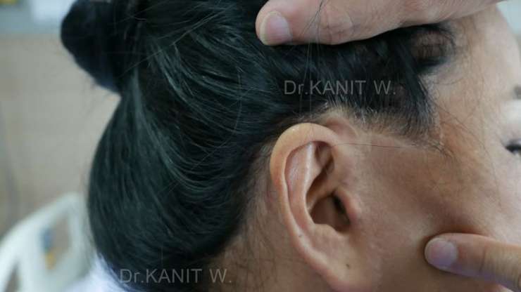 ปัญหาหลังดึงหน้าที่เกาหลี ?