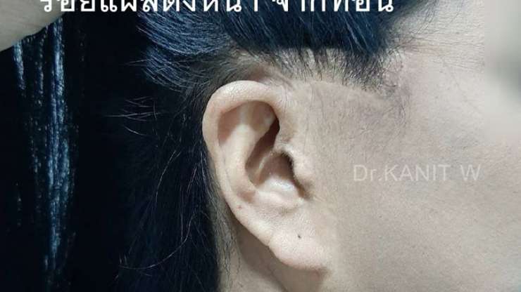 ไปดึงหน้าเกาหลี ดีมั้ย ?