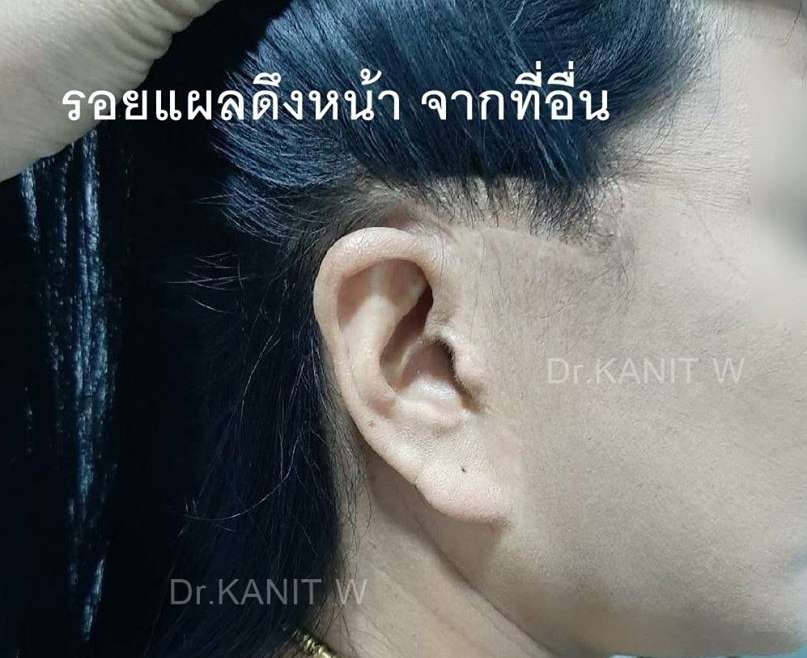 ไปดึงหน้าเกาหลี ดีมั้ย ?