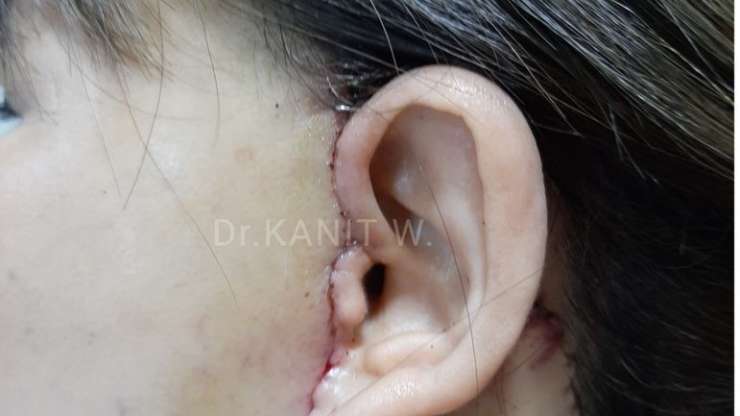 ตำแหน่งแผลผ่าตัดดึงหน้า เย็บซ่อนแผล